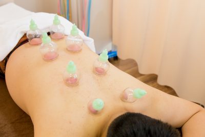 吸玉(カッピング)治療風景