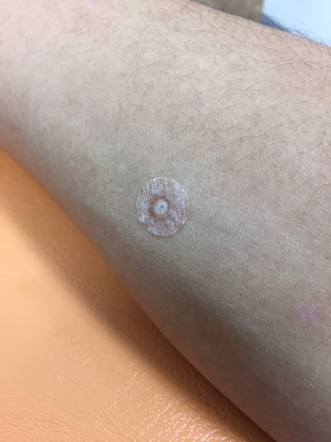 円皮鍼 えんぴしん というものをご存じですか ゆうき鍼灸接骨院