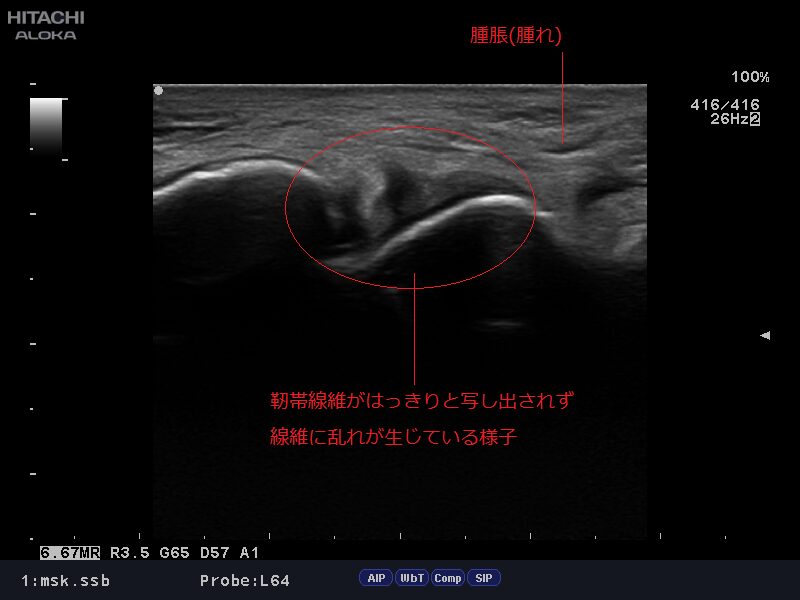 エコー画像前距腓靭帯損傷