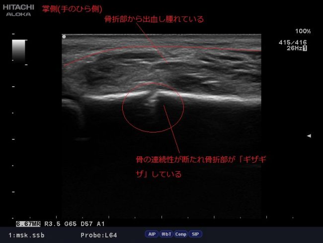 橈骨骨折のエコー画像