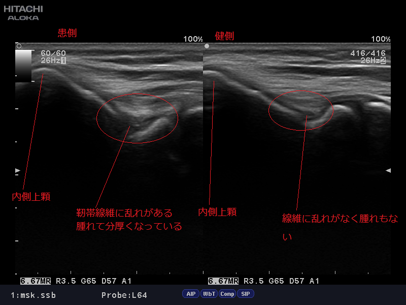 肘の内側側副靭帯損傷 Mcl Injury について ゆうき鍼灸接骨院