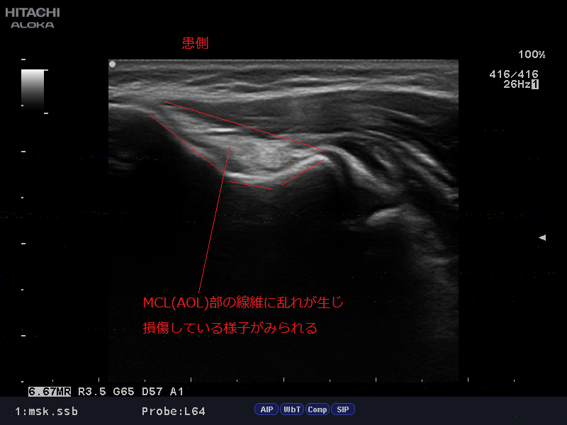 肘の内側側副靭帯損傷 Mcl Injury について ゆうき鍼灸接骨院