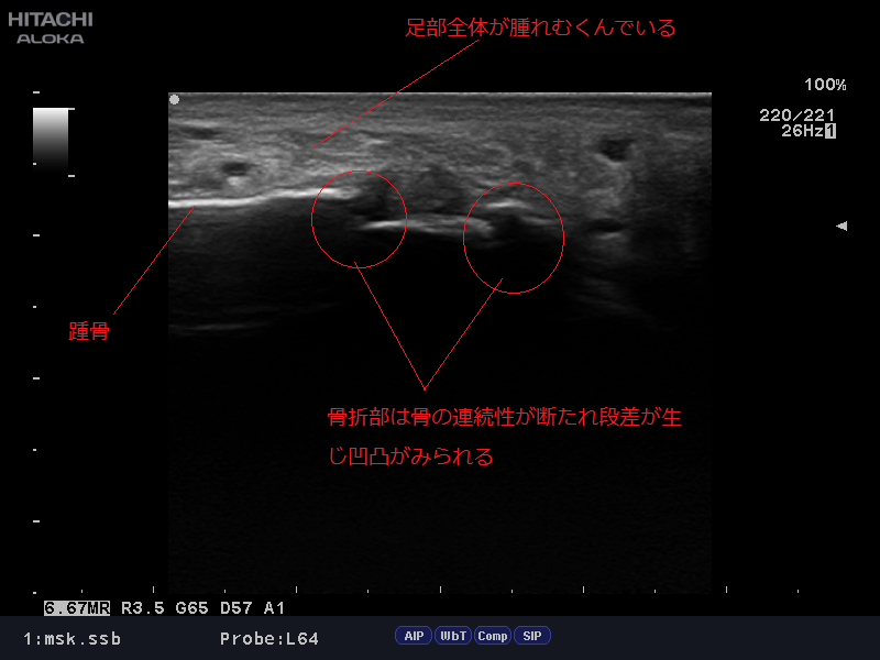 踵骨 かかとの 骨折について Calcaneus Fracture ゆうき鍼灸接骨院