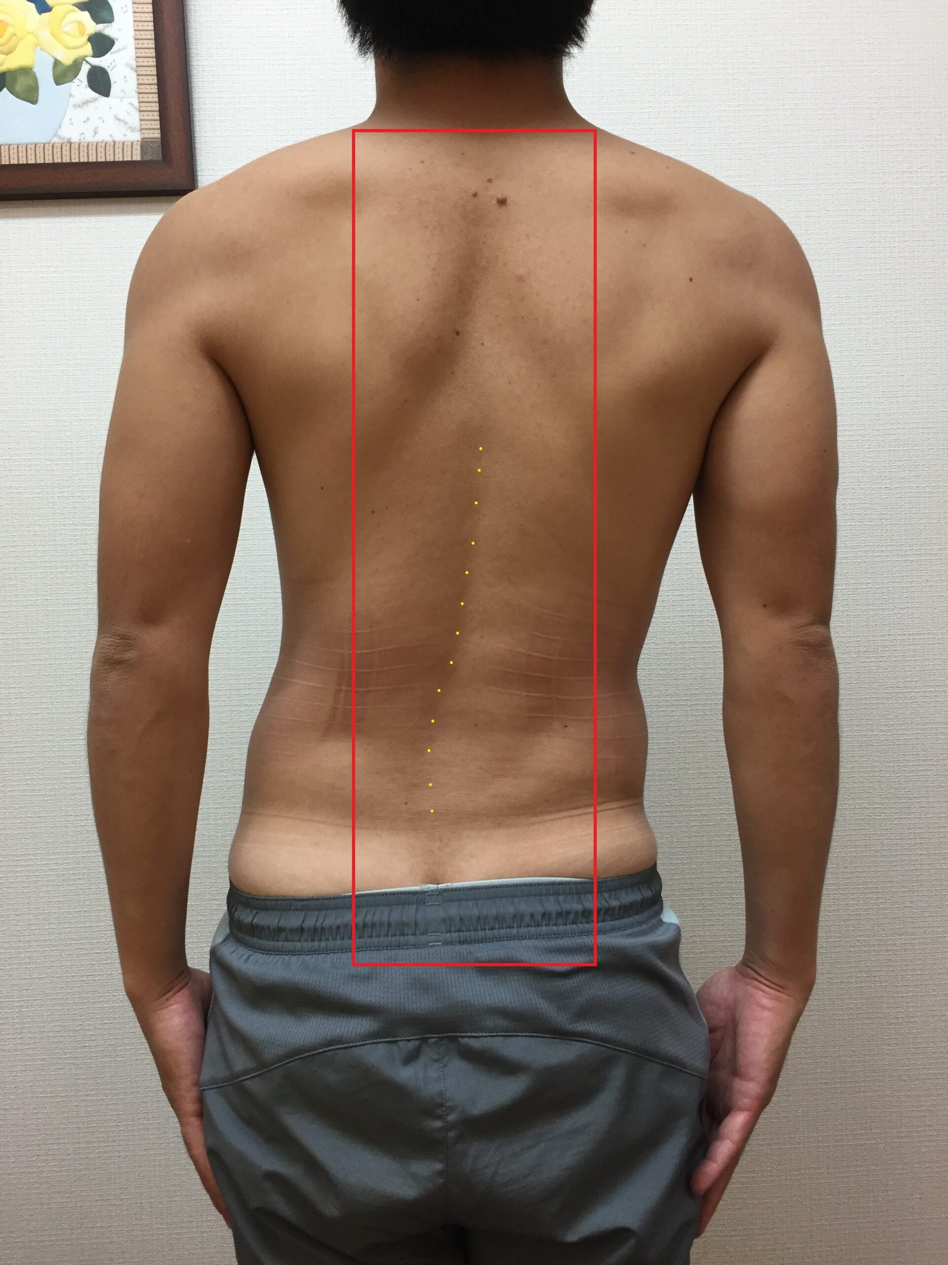 腰痛による疼痛性側弯とは?