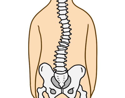 腰痛で背骨が曲がる?疼痛性側弯をご存知ですか?