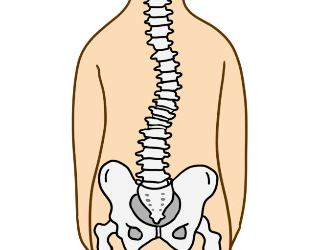 腰痛で背骨が曲がる?疼痛性側弯をご存知ですか?