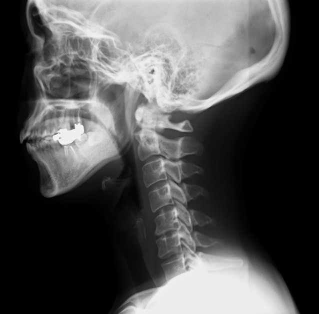 レントゲンを撮っても異常はみられない。という場合も多い