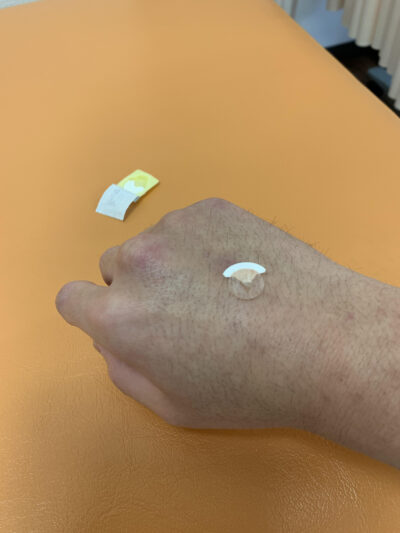 円皮鍼(えんぴしん)というものをご存じですか?