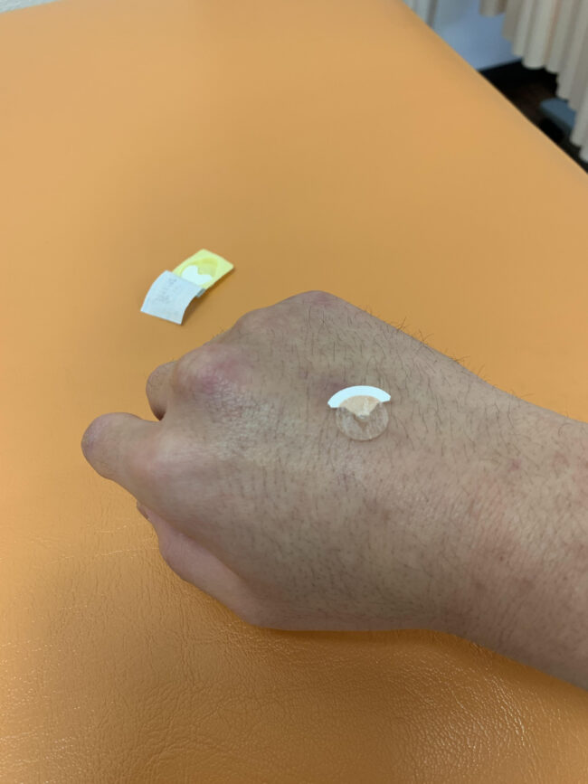 円皮鍼(えんぴしん)というものをご存じですか?