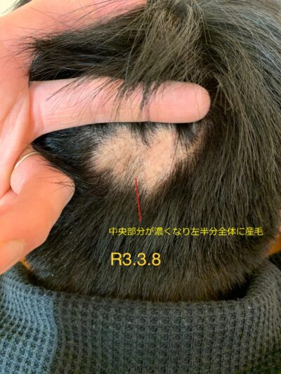 円形脱毛症には鍼灸が効果的 原因や治療効果を１から徹底解説 ゆうき鍼灸接骨院