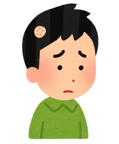 円形脱毛症には鍼灸が効果的。原因や治療効果を1から徹底解説