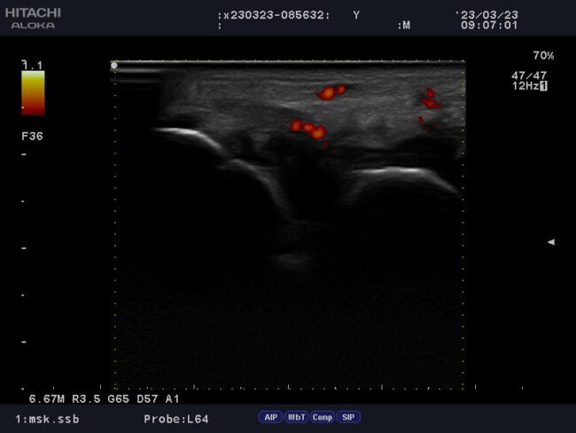 手関節部分のリウマチによる炎症(エコー画像)