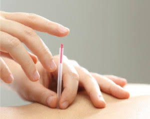 鍼灸治療の施術風景